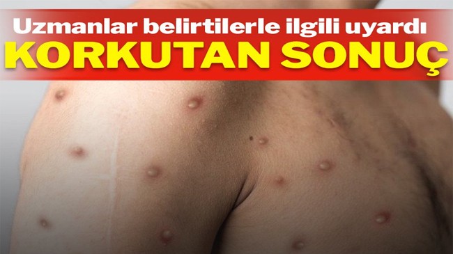 Maymun çiçeği semptomları önceki salgınlardan farklı